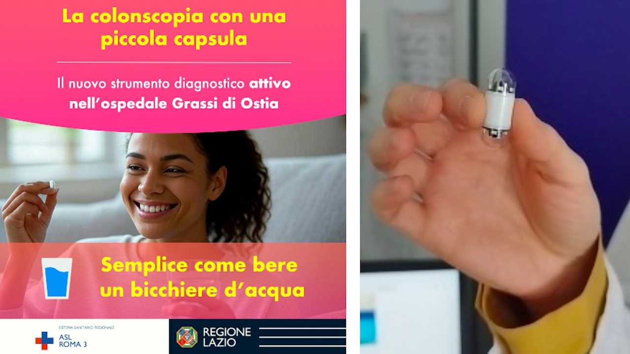 Ostia, al Grassi arriva il dispositivo alternativo alla colonscopia: per lo screening basta una capsula