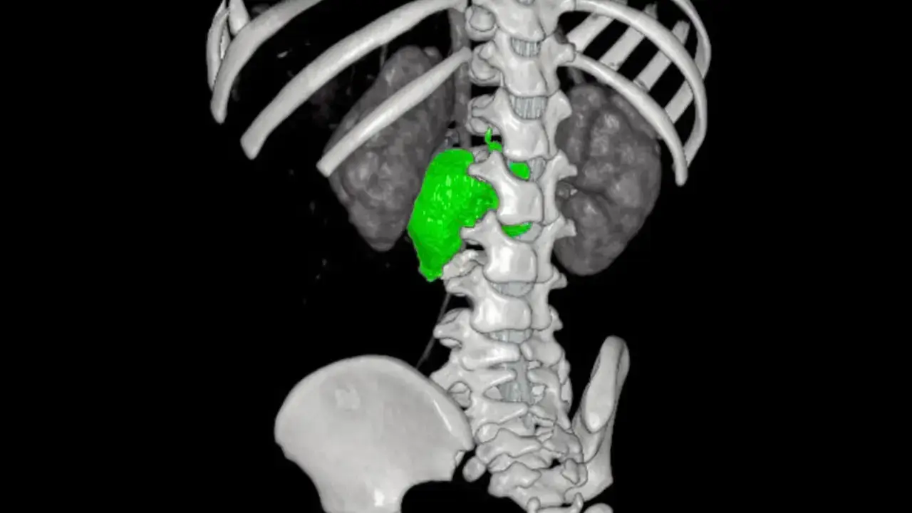 Bambino Gesù, nuova strategia integrata rimuove un complesso neuroblastoma
