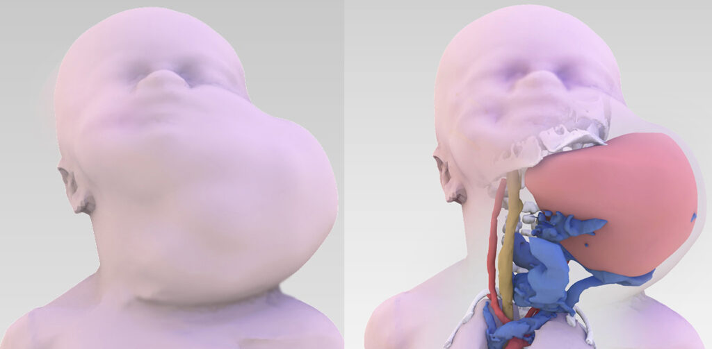 IMMAGINE 3D massa tumore EXIT ECMO duo