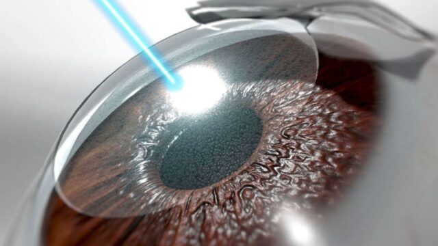 chirurgia refrattiva oculistica remoto occhi
