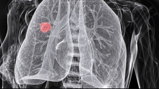 tumore polmone farmaco